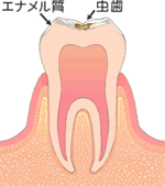 歯の表面（エナメル質）のむし歯