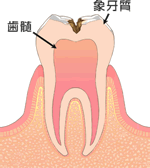 歯の中（象牙質）のむし歯