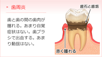 歯周炎　歯と歯の間の歯肉が腫れる。あまり自覚症状はない。歯ブラシで出血する。あまり動揺はない。 